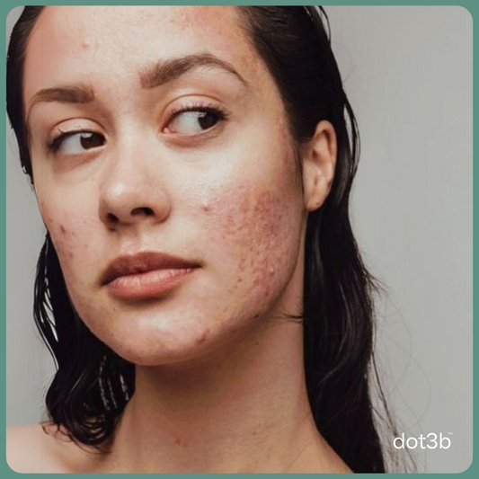 Fade Post-Acne Marks