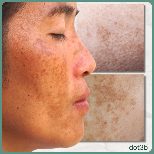 Tackling Hyperpigmentation