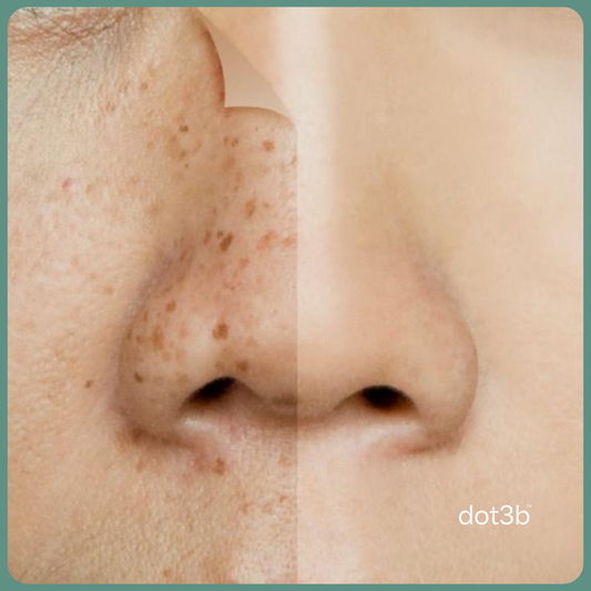Niacinamide for Dark Spots - Does It Actually Work?