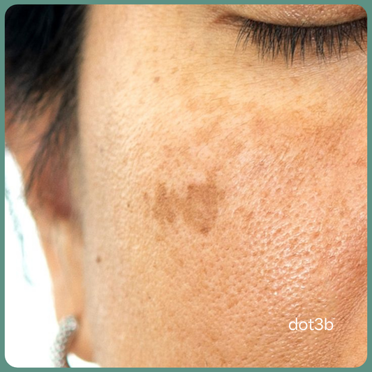 Niacinamide vs Vitamin C - Which Is Better for Dark Spots?