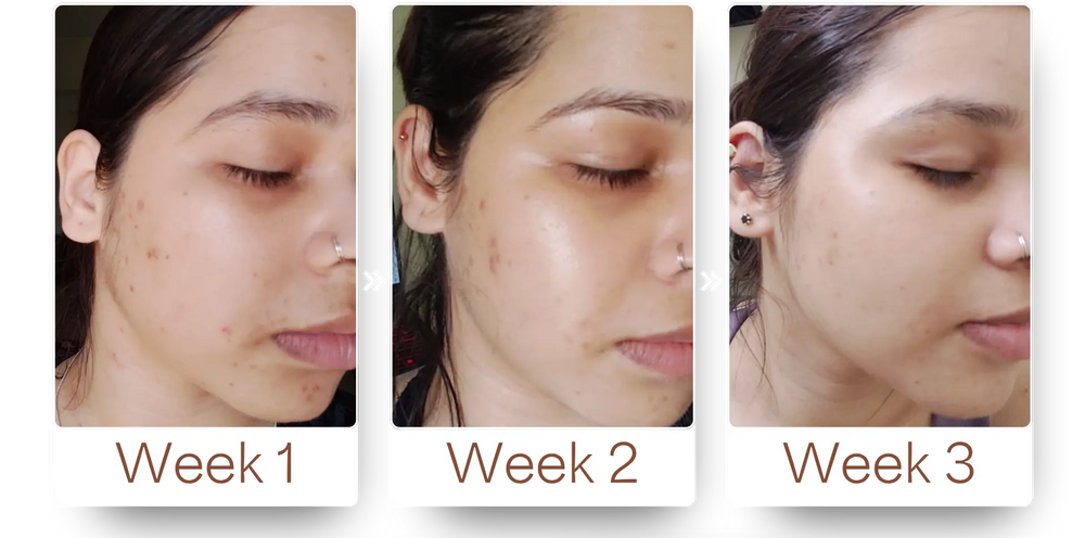 Customer skin progress showing changes from Week 1 to Week 3