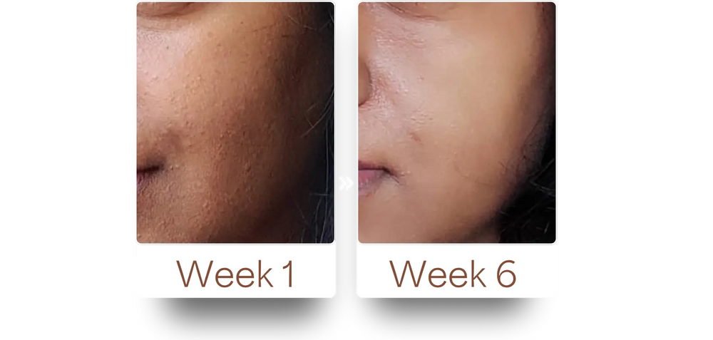 Customer skin progress showing changes from Week 1 to Week 6